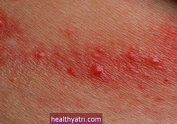 Alergii - Cauze și factori de risc ai dermatitei de contact