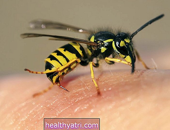Überblick über Bienenstichreaktionen und Allergien