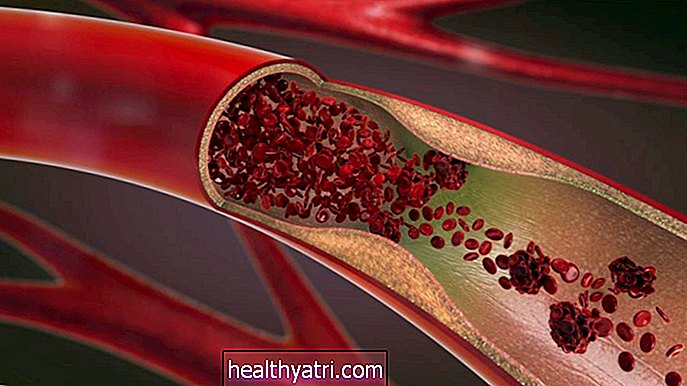 Mis on arterioskleroos?