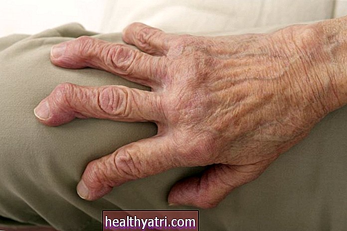 Pregled artritisa mutilansa