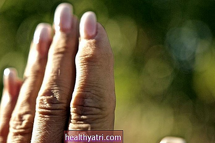 Kostné ostrohy v rukách: príčiny a liečba