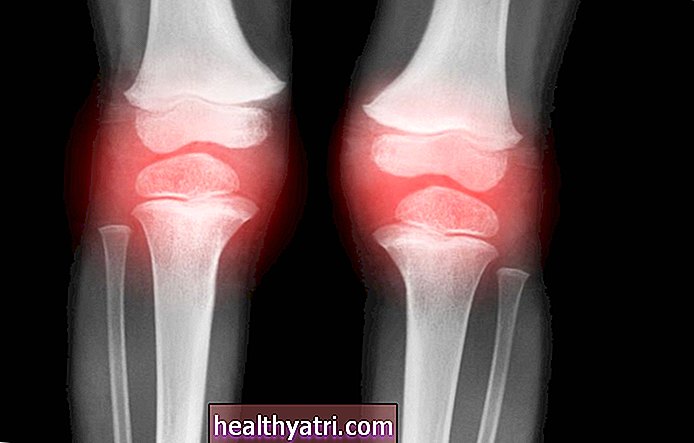¿Se puede revertir la osteoartritis?