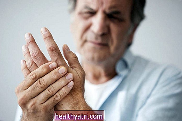 Kaip gydomas artritas