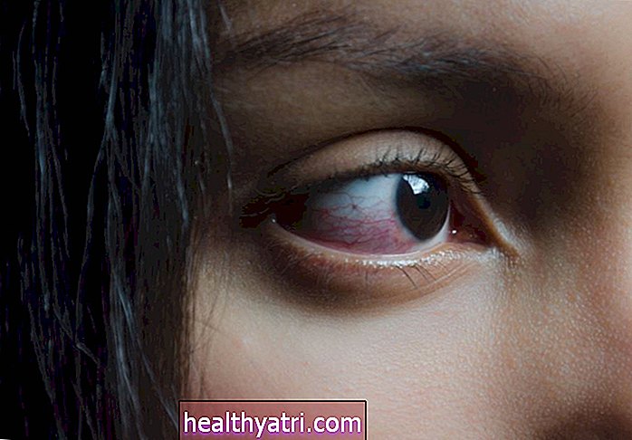 Kā reimatoīdais artrīts ietekmē jūsu acis?