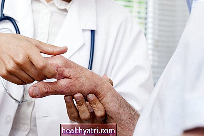 Kaip psoriazinis artritas veikia rankas