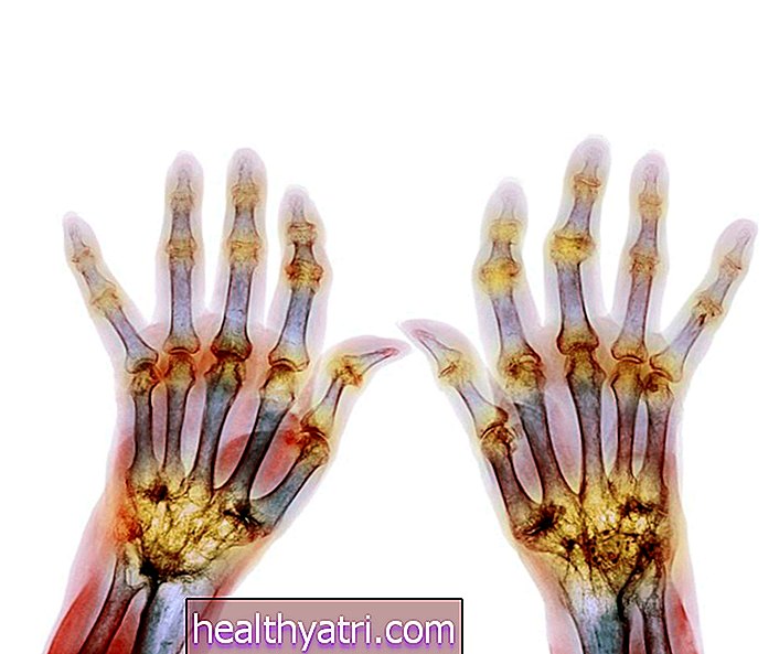 Bagaimana Rheumatoid Arthritis Mempengaruhi Setiap Bahagian Tubuh