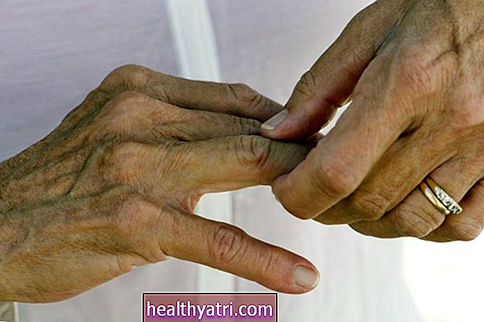 Як позбутися від артриту на пальцях рук