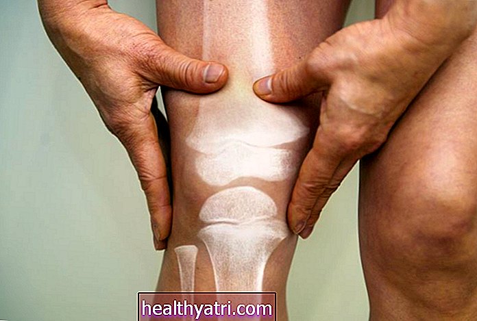 Prevención de la artritis reumatoide