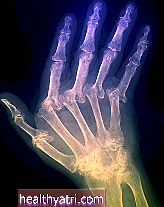 Deriva cubital en la artritis reumatoide y otras enfermedades