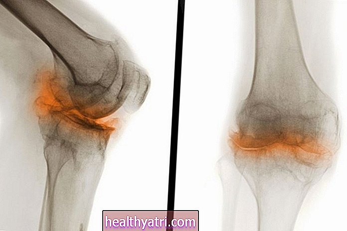 Unloader Knee Brace for Artrose