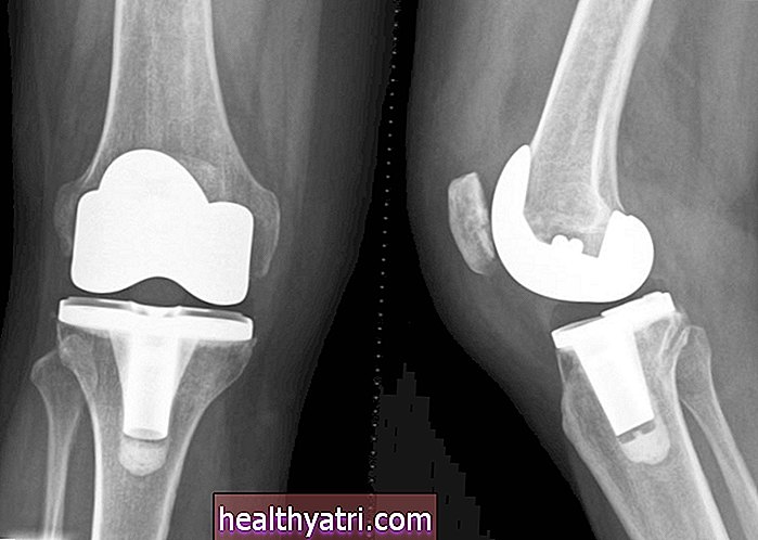 Що слід знати про тотальну хірургію колінного суглоба