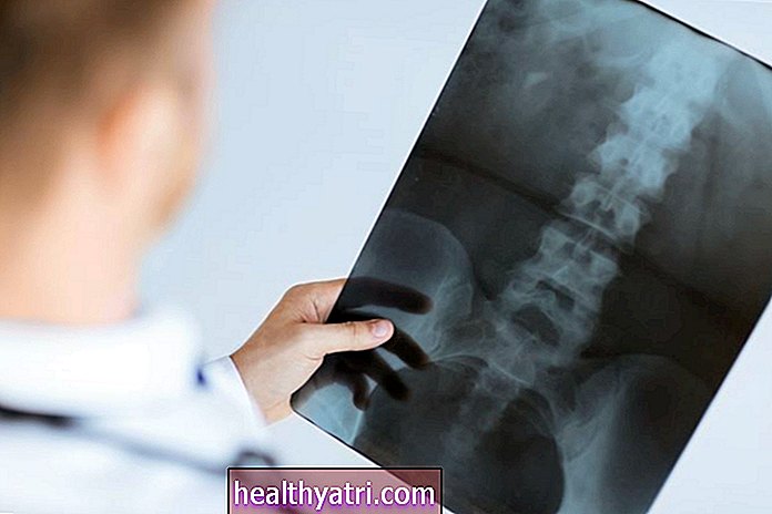 Una descripción general de las lesiones espinales