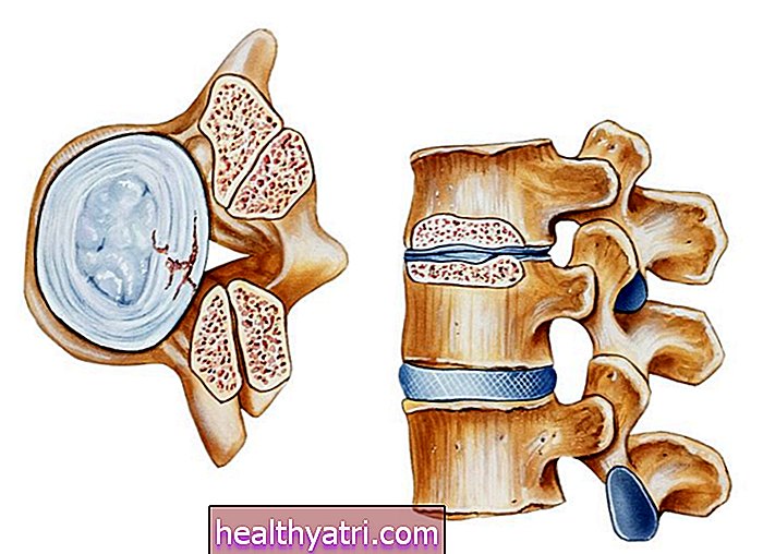 Kaj je hrbtenična stenoza?
