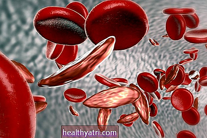 10 речей, які ви повинні знати про серповидноклітинні захворювання