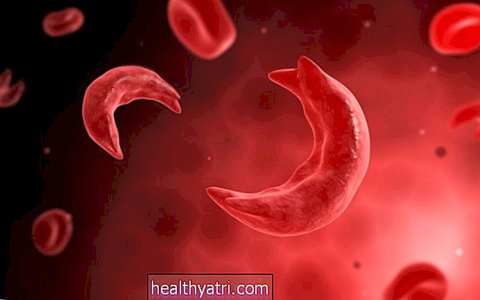 Una descripción general de la anemia de células falciformes