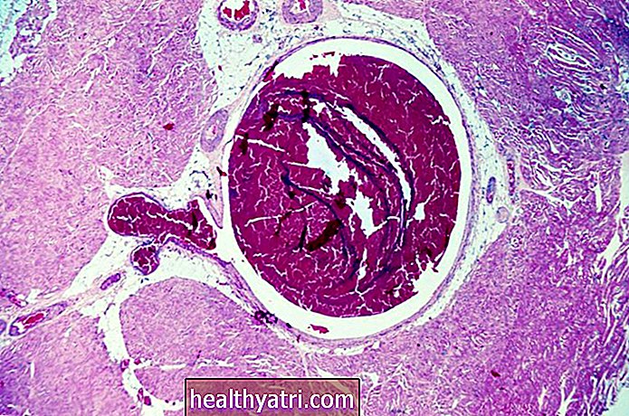 ¿Qué es la trombosis venosa profunda?