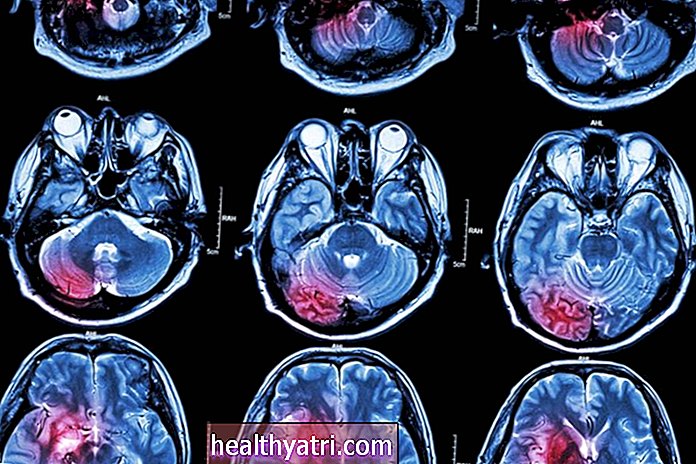 Anticoagulare și prevenirea accidentului vascular cerebral în A-Fib
