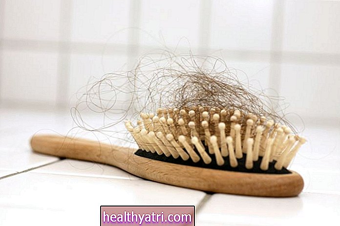 Ztráta vlasů může být známkou zvýšeného rizika mrtvice