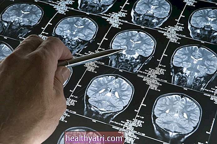 Mozga - Živčanog Sustava- - Kako se dijagnosticira Alzheimerova bolest