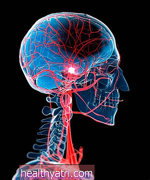 Signos y síntomas de un accidente cerebrovascular
