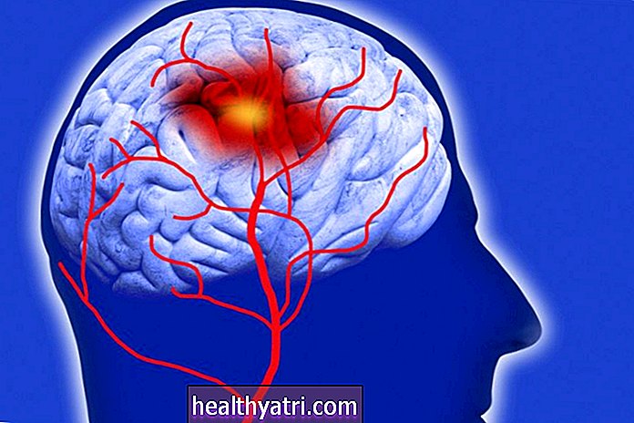 Accidente cerebrovascular causado por angiopatía amiloide
