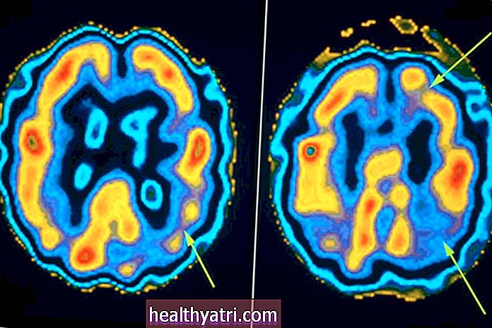 Las 7 etapas y síntomas de la enfermedad de Alzheimer