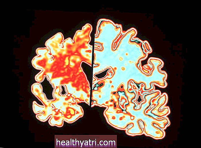 मस्तिष्क पर अल्जाइमर का प्रभाव