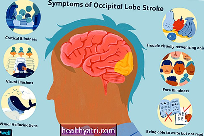 Los efectos de un accidente cerebrovascular en el lóbulo occipital