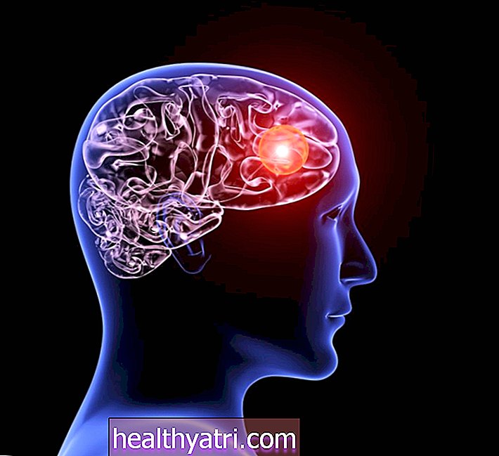 ¿Qué es un aneurisma cerebral?