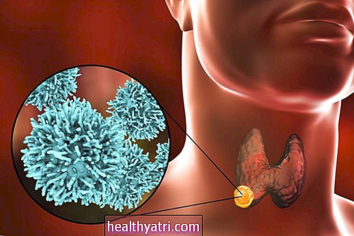Una descripción general del cáncer de tiroides papilar