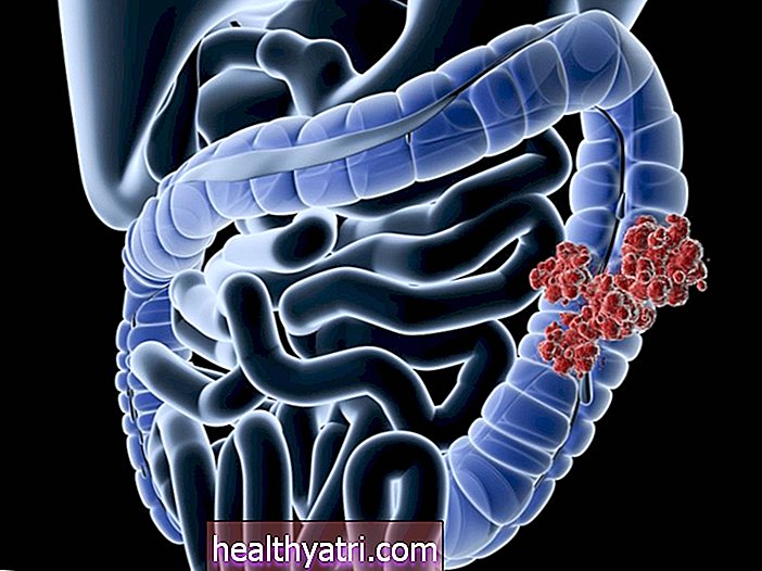 Causas y factores de riesgo del cáncer de colon
