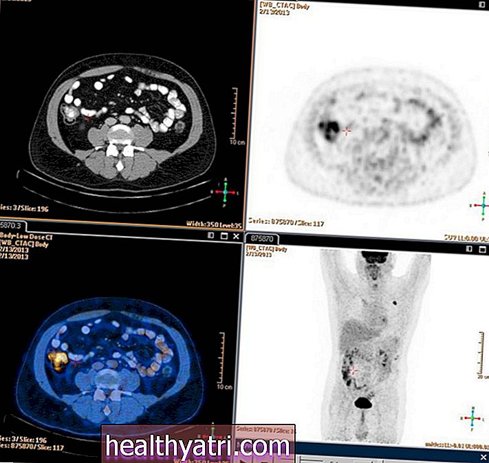 Hodgkini lümfoom ja PET / CT roll