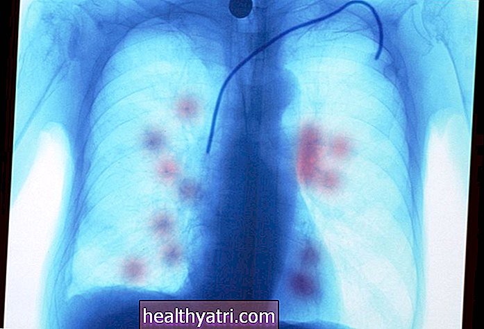 En qué se diferencia el cáncer metastásico de los pulmones del cáncer de pulmón primario