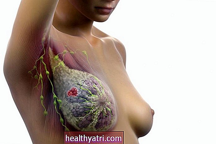 Стан лімфатичних вузлів та рак молочної залози