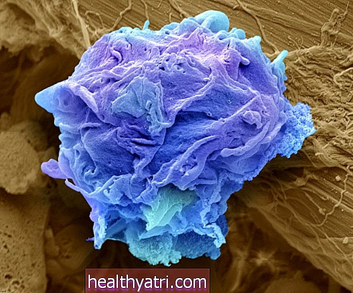 Rakovina - Lymfom: příznaky, příznaky a komplikace
