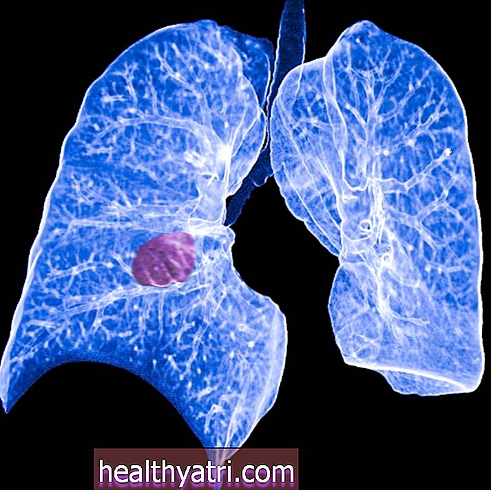 Первинний і вторинний рак легенів