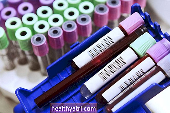 Test LDH za melanom in odkrivanje metastaz