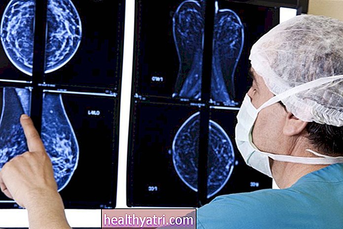 Grados de tumor y cáncer de mama