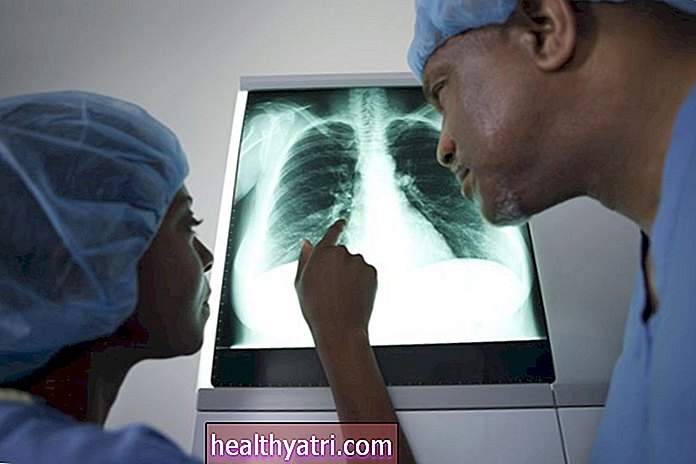 Kas ir plaušu karcinoīdie audzēji?
