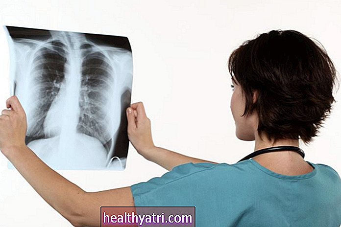 ¿Qué son los nódulos pulmonares solitarios?