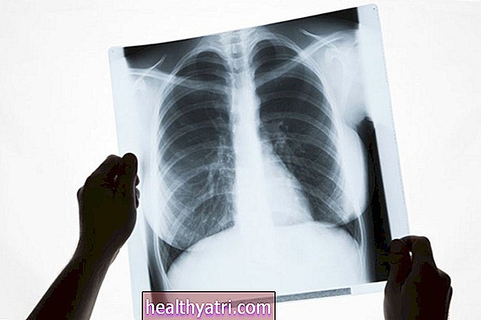 ¿Qué es el cáncer de pulmón ALK positivo?