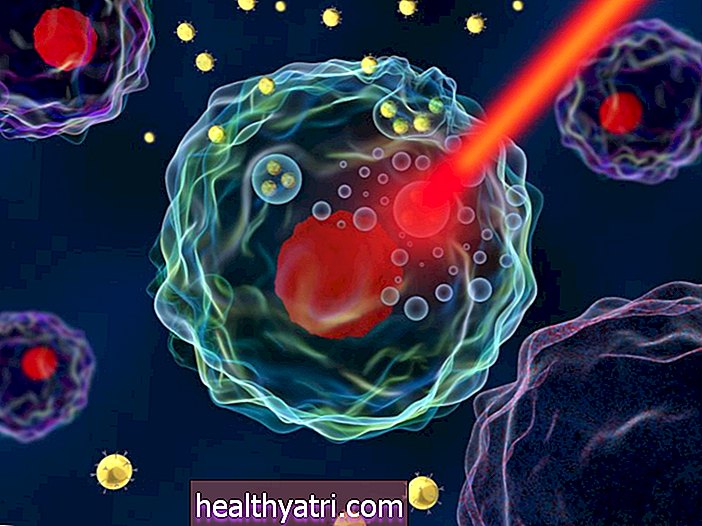 Kaj je hipertermija za zdravljenje raka?