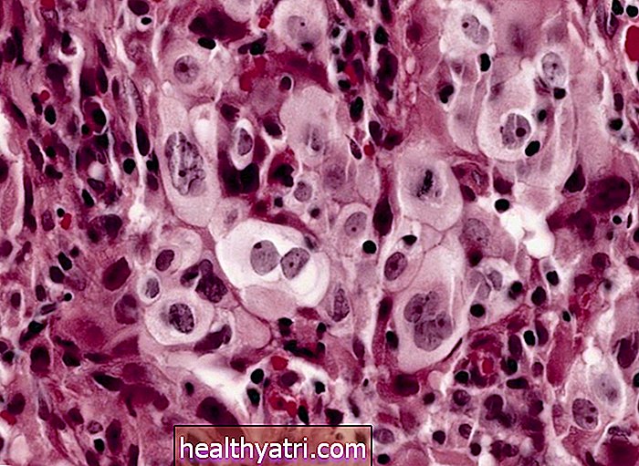 ¿Qué es el carcinoma de pulmón de células grandes?