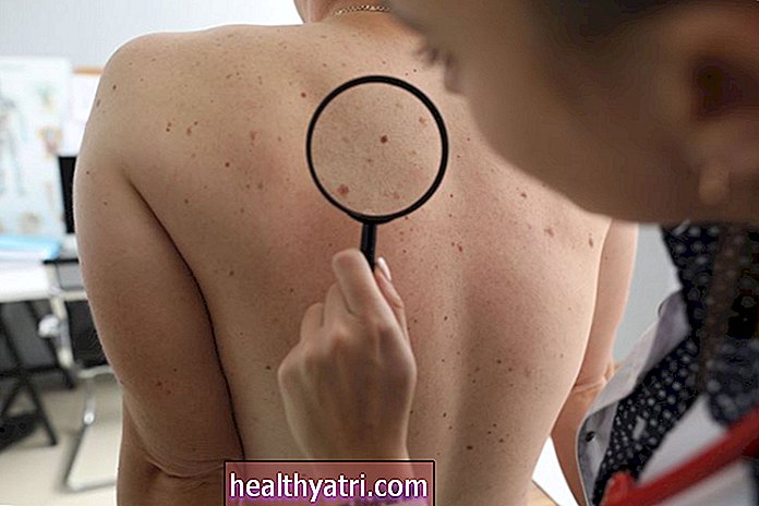 Kas ir nemelanomas ādas vēzis?