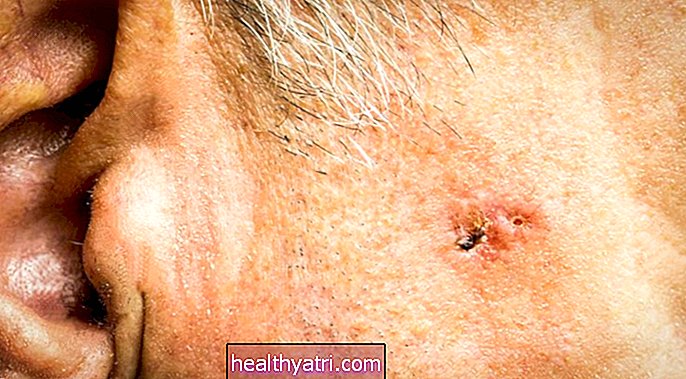 Який тип раку шкіри з’являється на вусі?