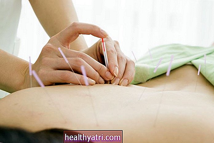 Akupunktur untuk Sindrom Keletihan Kronik