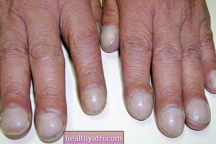 Una descripción general de las palizas de los dedos