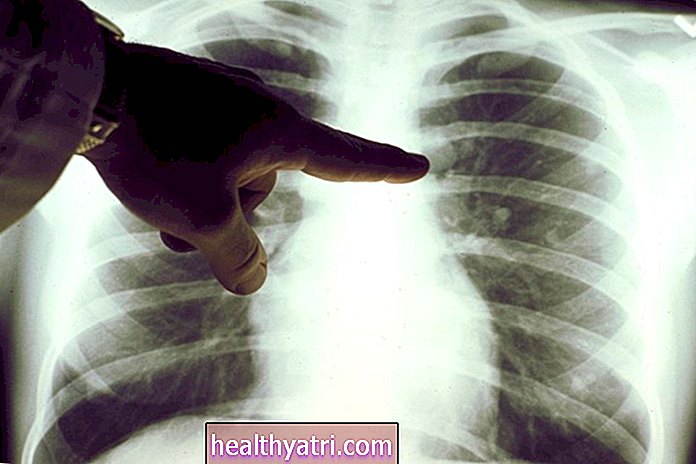 Trasplantes de pulmón para tratar la EPOC