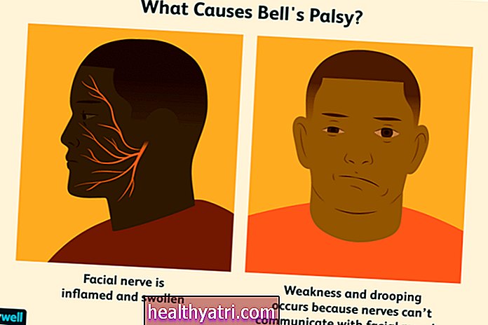 Bell's Palsy dalam Ujian Vaksin COVID-19: Mengapa Anda Tidak Perlu Bimbang