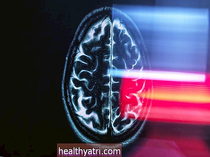 Skenovanie mozgu odhaľuje dlhodobé neurologické účinky COVID-19